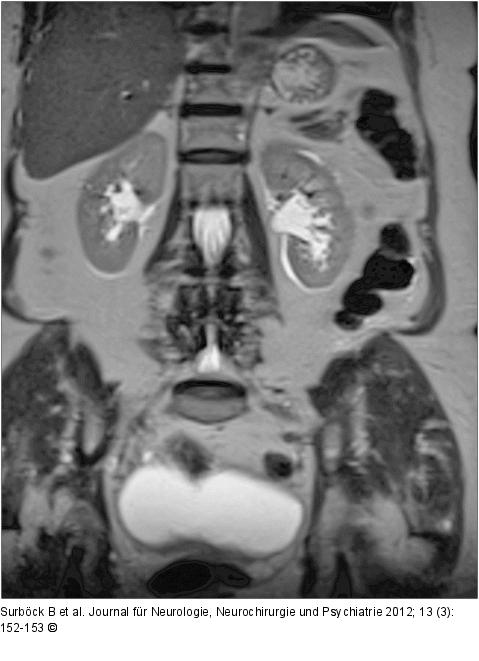 Arteria-spinalis-anterior-Syndrom
