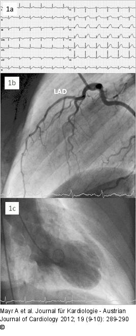 STEMI