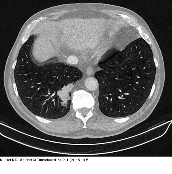 Thorax-CT