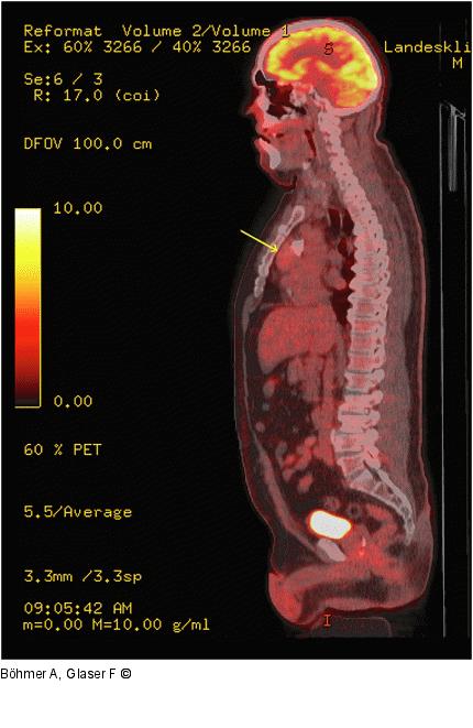 Tumor