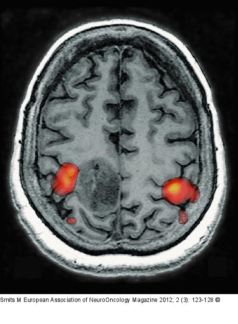 Brain tumour 