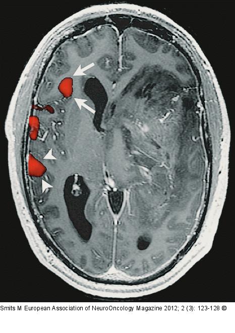 Brain tumour