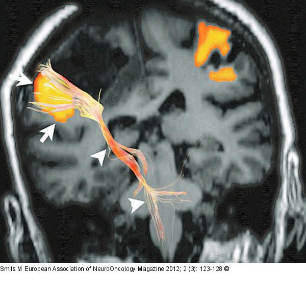 Brain tumour