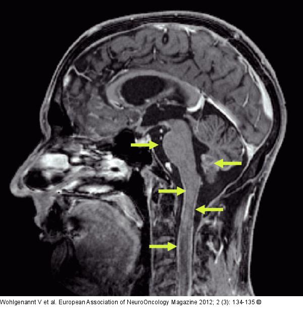 Glioblastoma