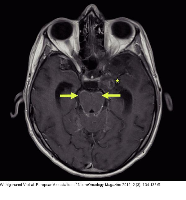 Glioblastoma