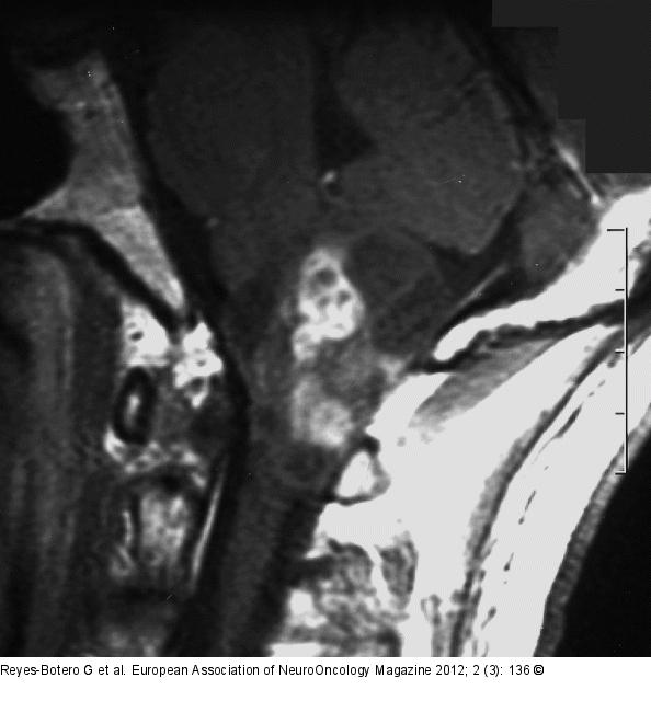 Brain tumour