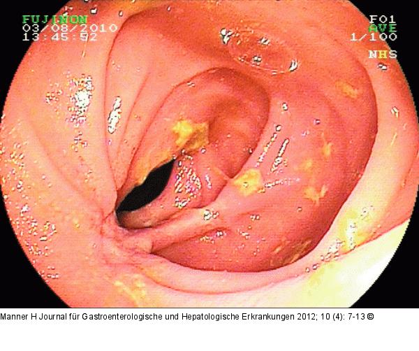 M. Crohn 