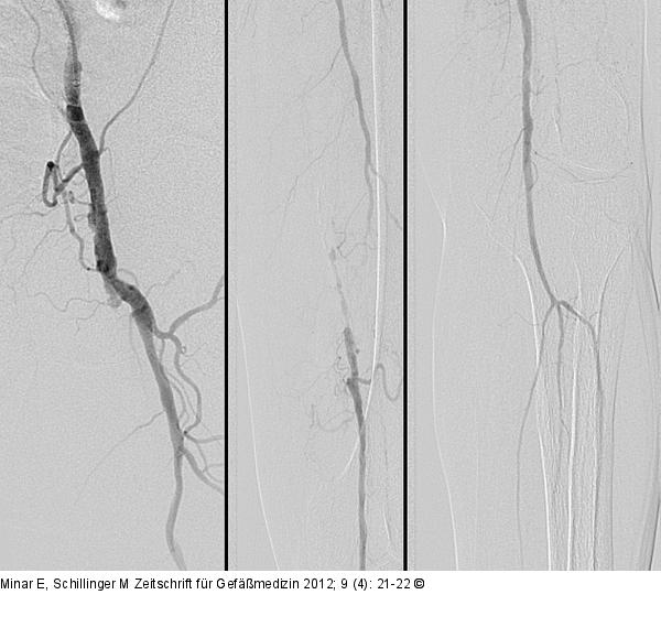 Angiogramm