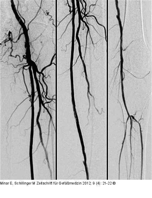 Ballondilatation