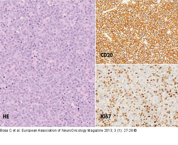 B-cell Lymphoma