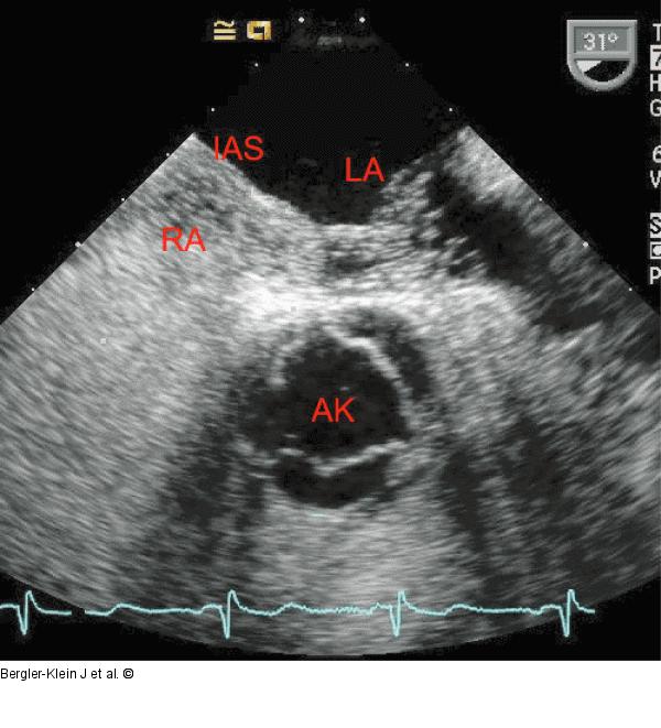 Offenes Foramen ovale