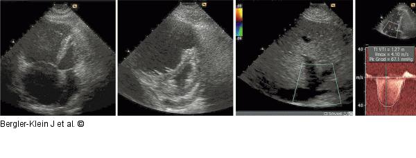Primär pulmonale Hypertonie