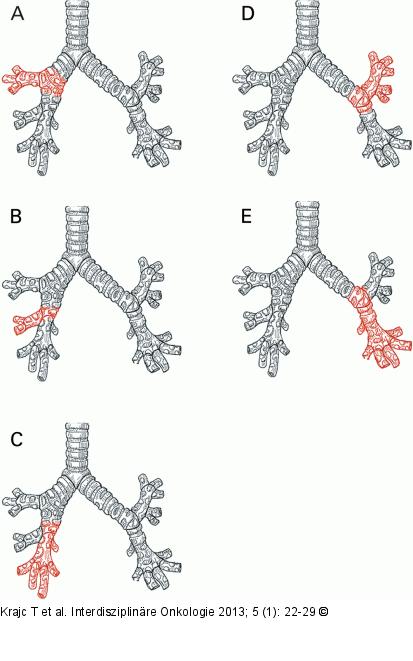 Manschetten-/Sleeve-Resektionen 