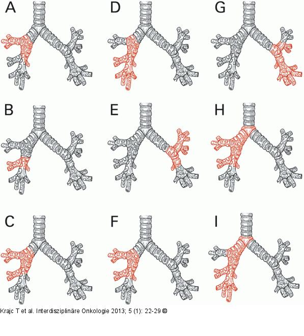 Manschetten-/Sleeve-Resektion