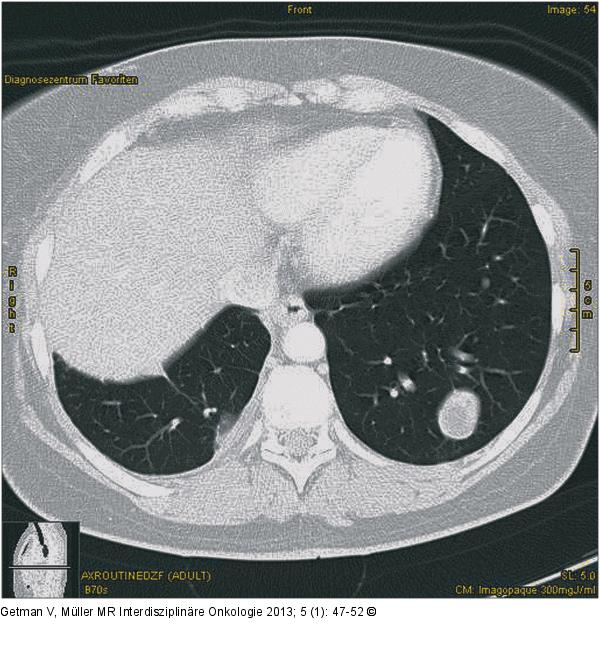 Thorax-CT