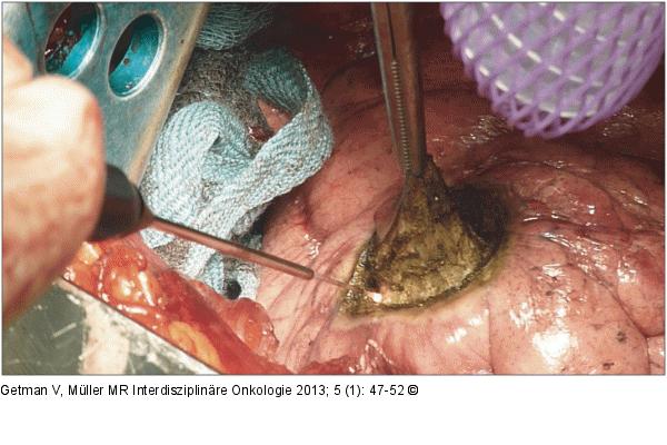 Lungenmetastase