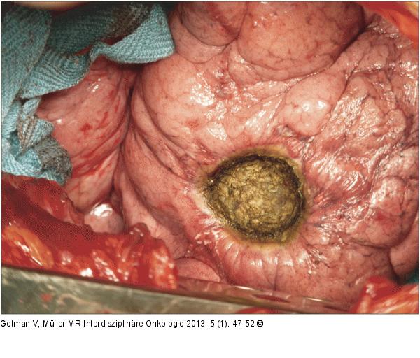 Lungenmetastase
