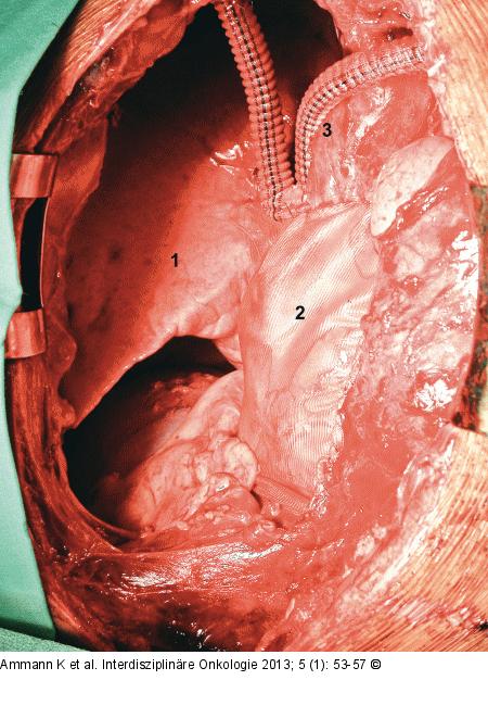 Thymus - Resektion