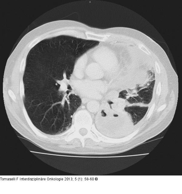 Thorax-CT