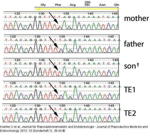 PGD for Spinal Muscular Atrophy, SMA