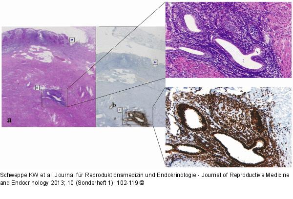 Endocrinically active endometriosis