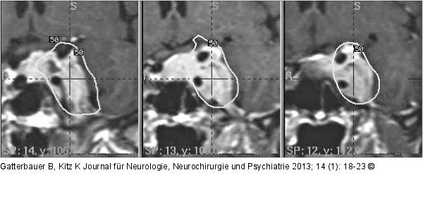 Gamma-Knife-Dosisplan