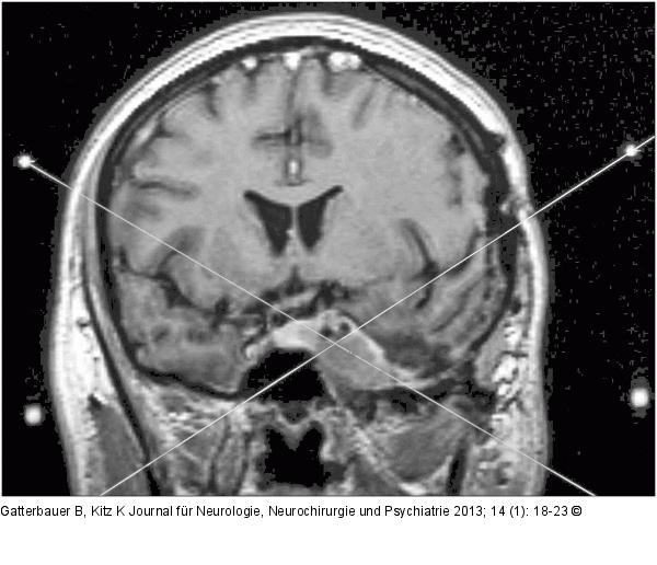 Sinus-cavernosus-Meningeom