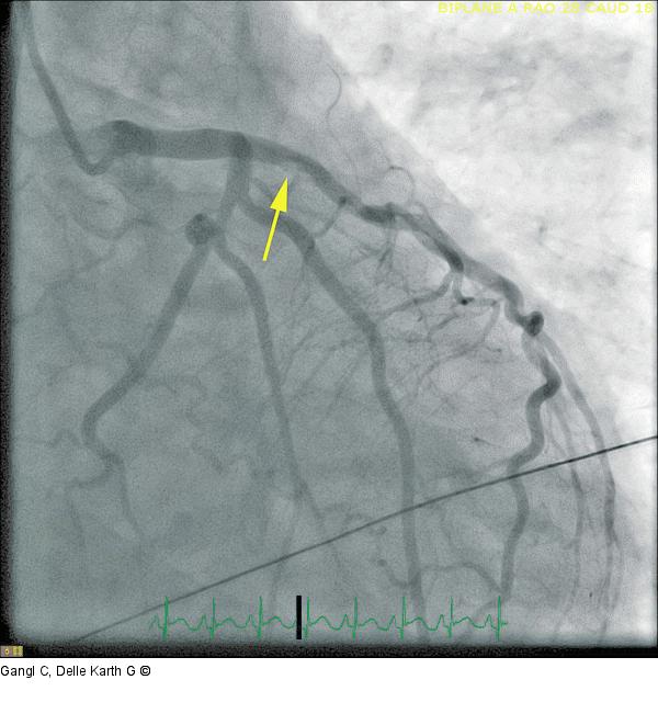 Initiale Angiographie