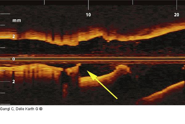 Stent-Gefäß-Mismatch