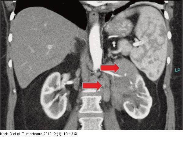 Lymphom