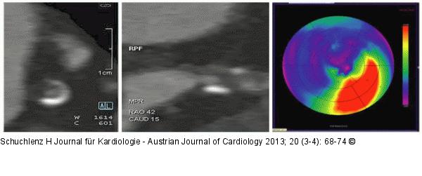 Herz-CT