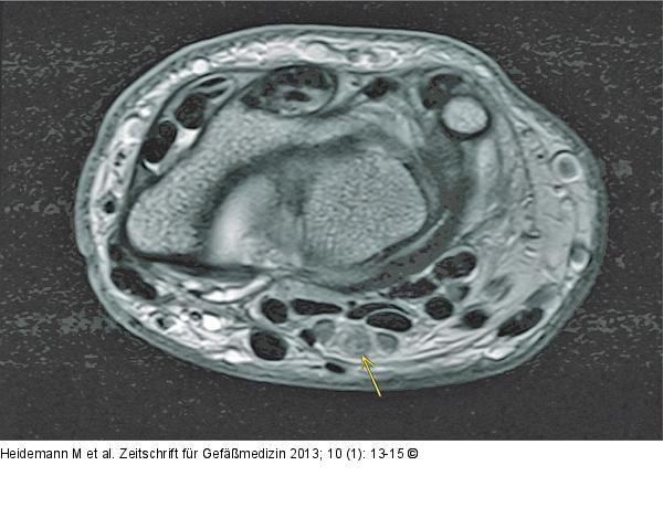 Karpaltunnelsyndrom