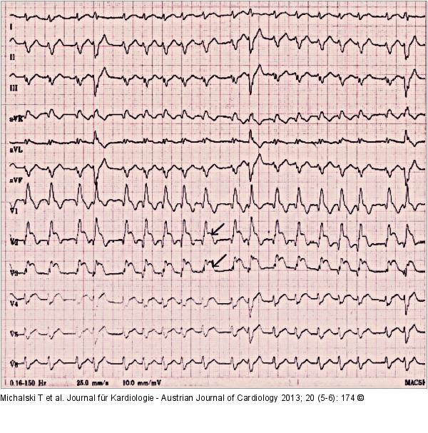 EKG