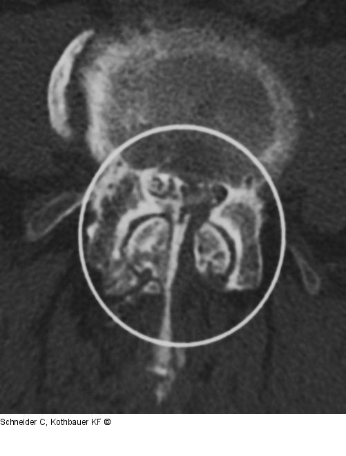 Facettensyndrom