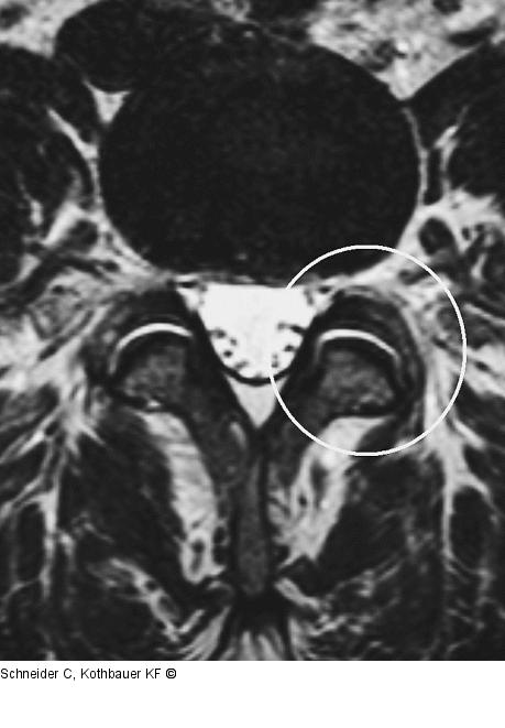 Facettensyndrom