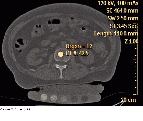 Quantitative Computertomographie
