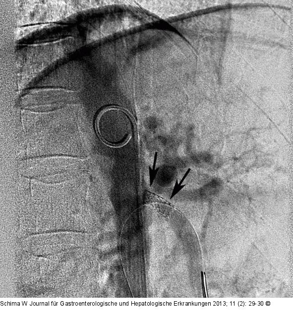 Stent
