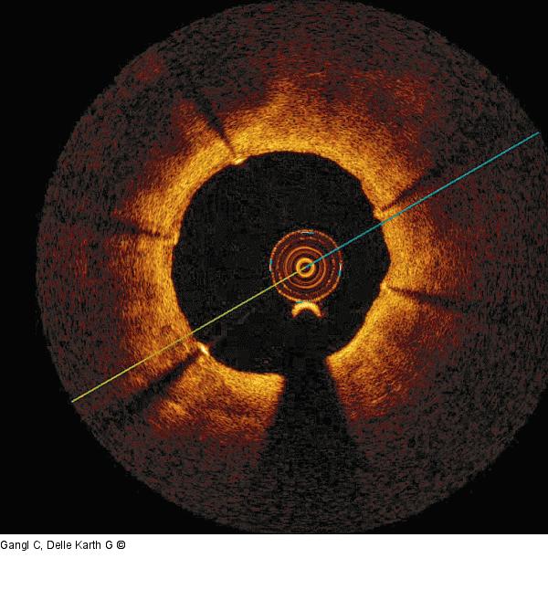 Aneurysma