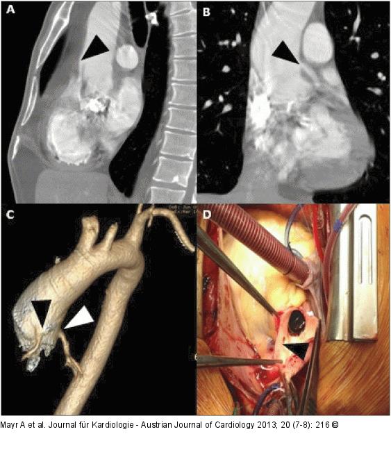 Coronary artery