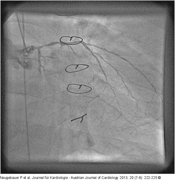 Catheter-Induced Dissection