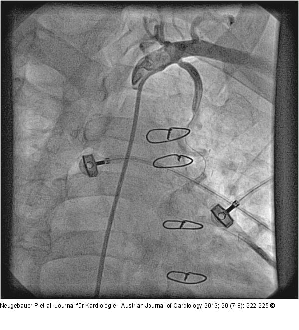 Catheter-Induced Dissection