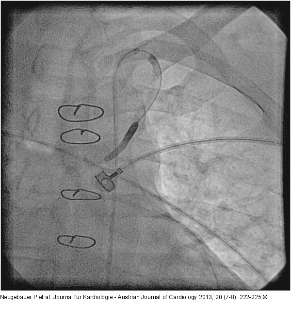 Catheter-Induced Dissection