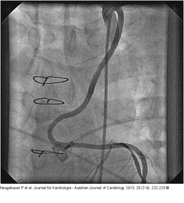 Catheter-Induced Dissection