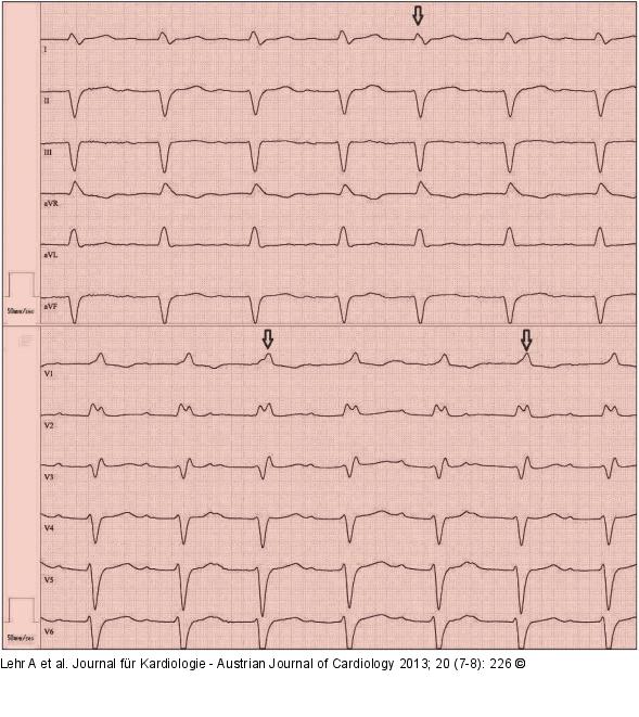 EKG