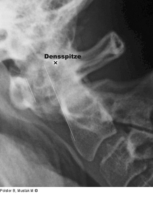 Rheumapatienten im OP