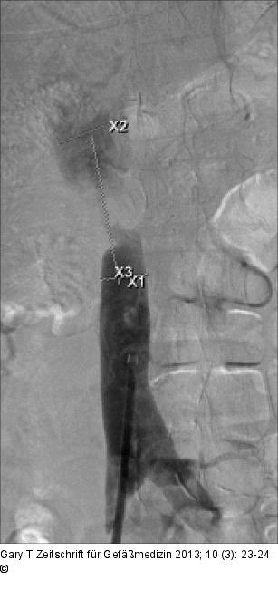 Venöses Stenting