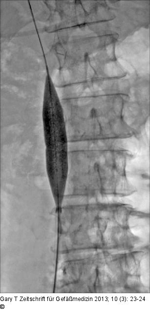 Venöses Stenting