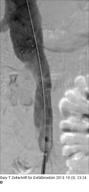 Venöses Stenting