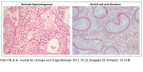 SCO-Syndrom