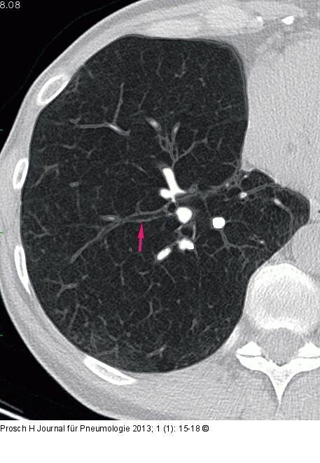 Computertomographie-COPD